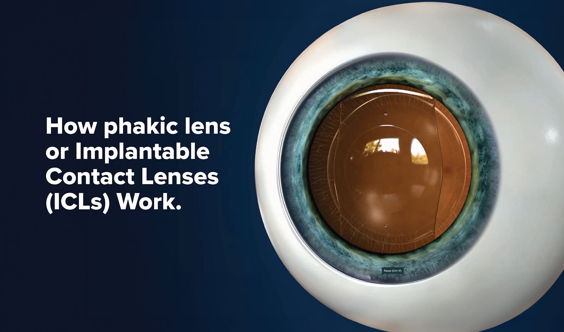 How Phakic Lensor Implantable Contact Lenses IC Ls Work