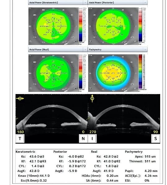 Topografia Corneal