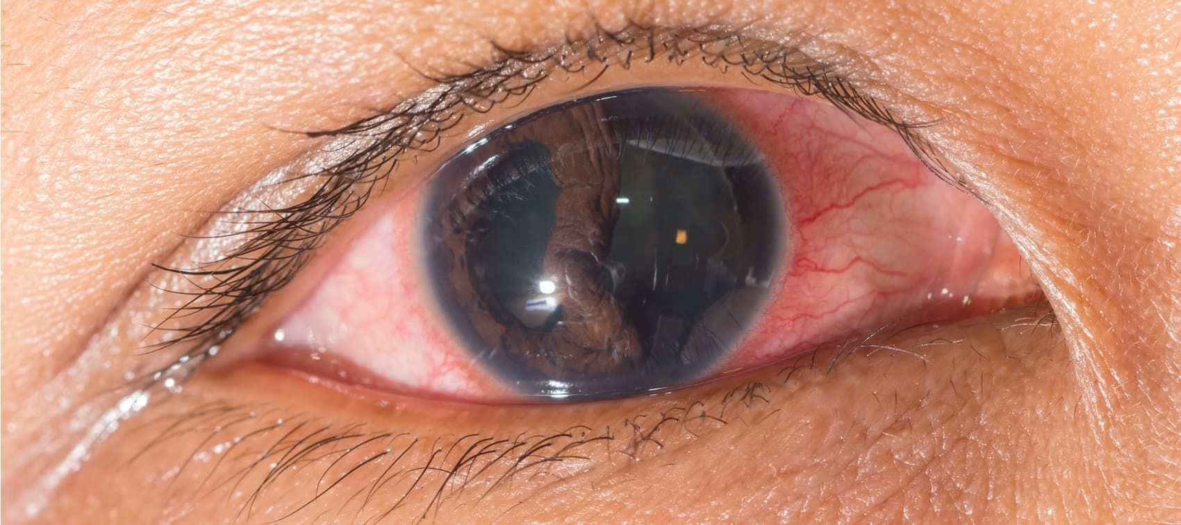 Desprendimiento de retina