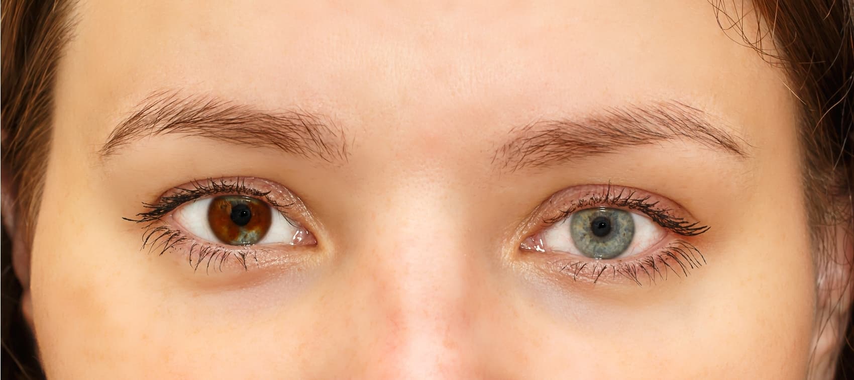Heterocromia