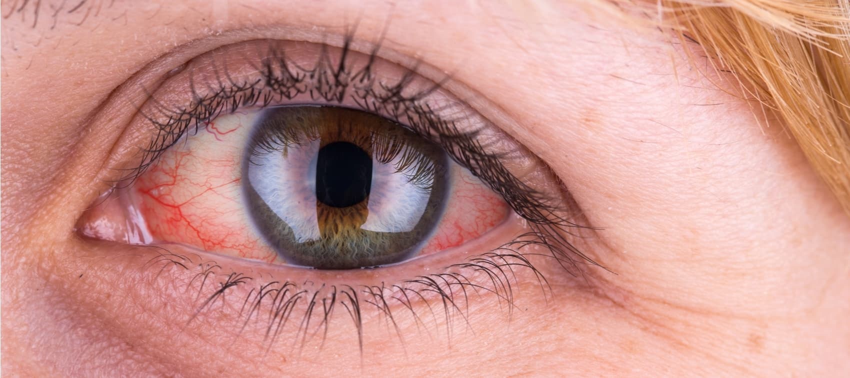 Conjuntivitis